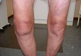Comment traiter l'arthrose de l'articulation du genou