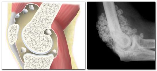 Chondromatose avec douleur dans l'articulation de la hanche.