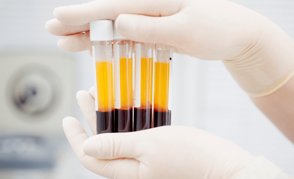 Plasma riche en plaquettes pour le traitement PRP dans l'arthrose